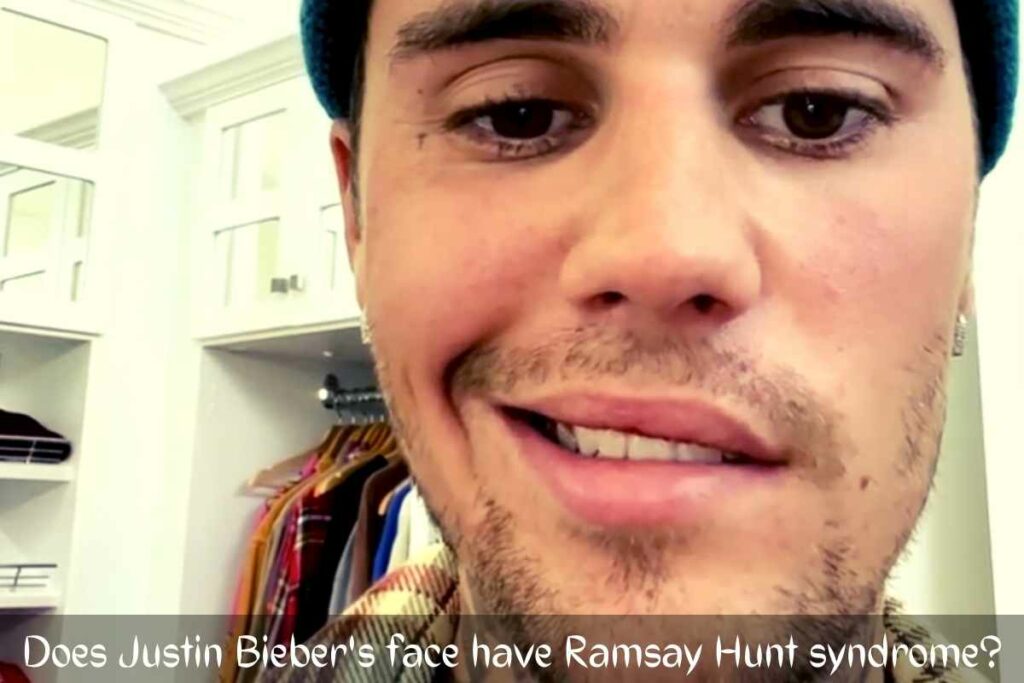 Does Justin Bieber's face have Ramsay Hunt syndrome