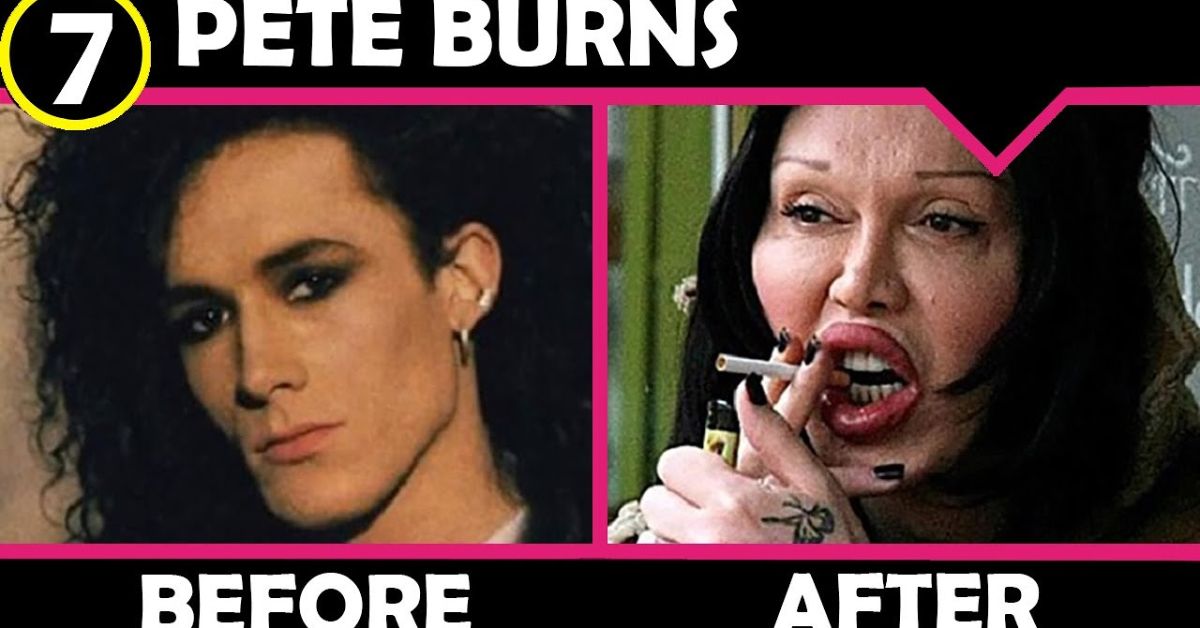 Pete Burns's Plastic Surgery: "Right Round" Singer's Own Words