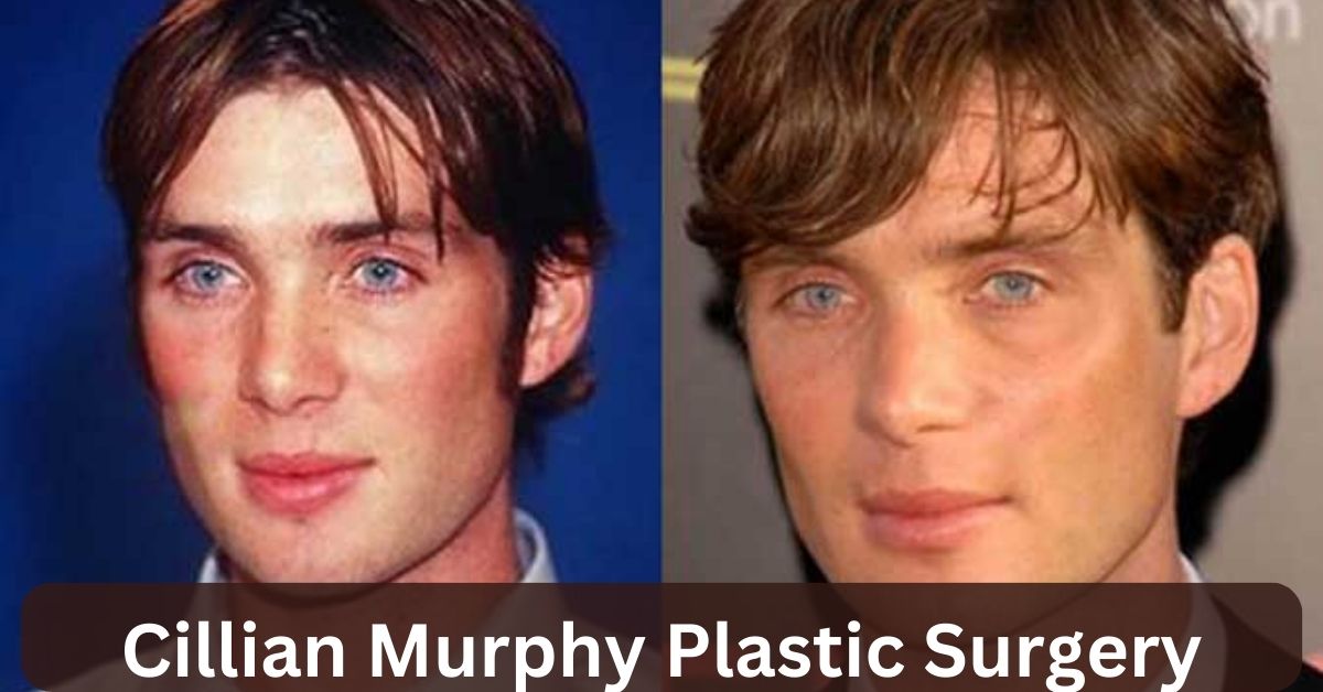 Cillian Murphy Plastic Surgery