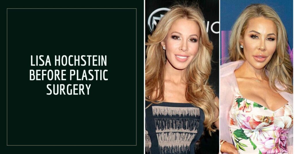 Lisa Hochstein Before Plastic Surgery